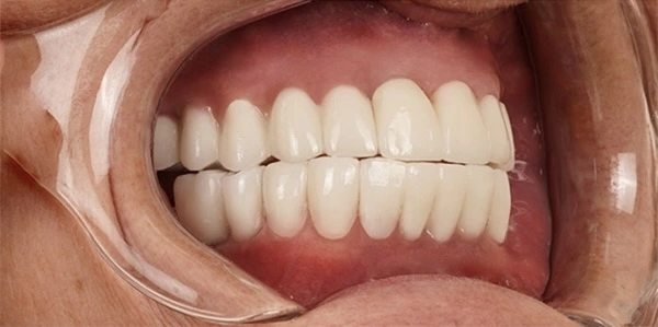 before-after-dental-implant-2-2