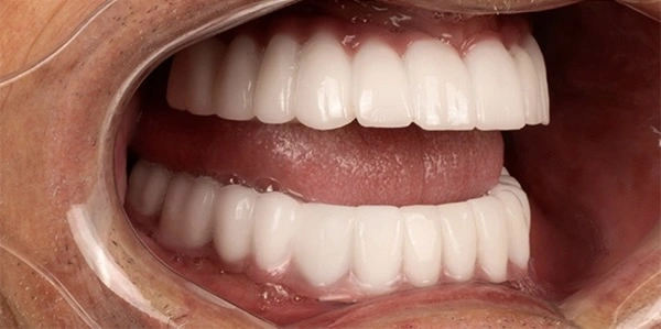 before-after-dental-implant-3-2