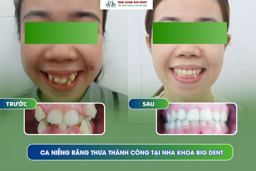 niềng răng thưa