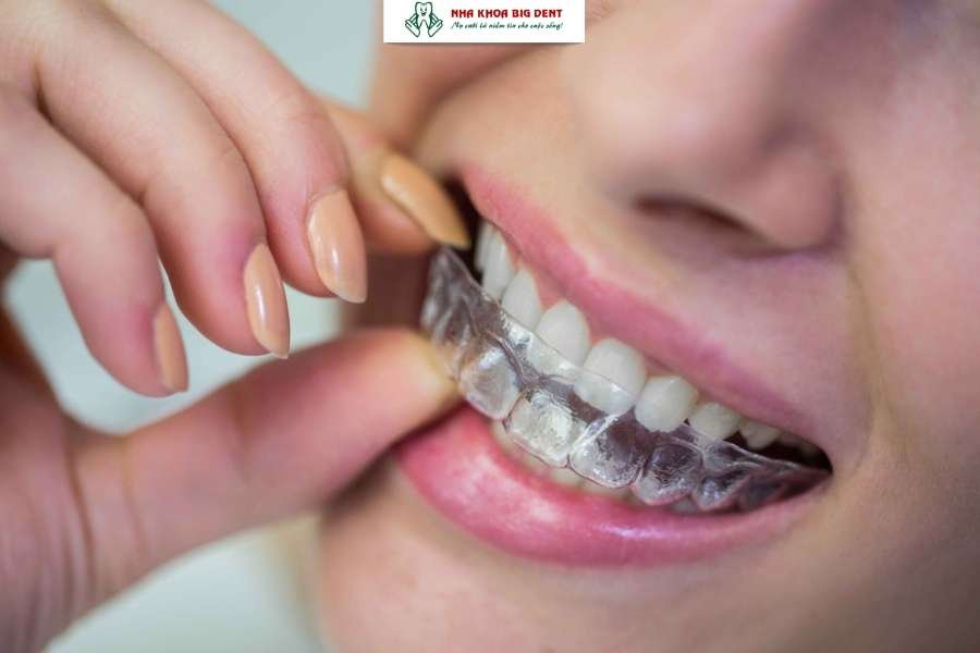 niềng răng trong suốt