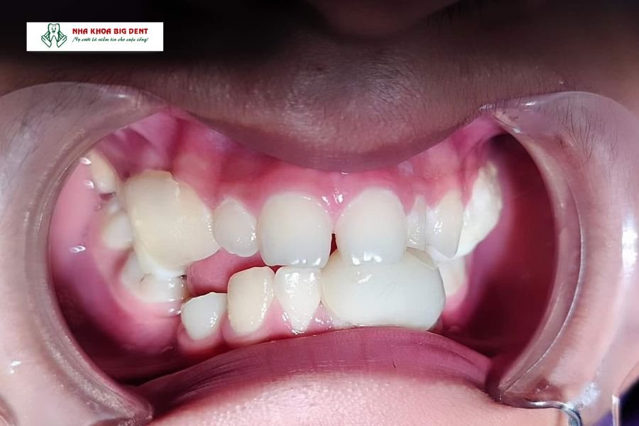 giá niềng răng trong suốt