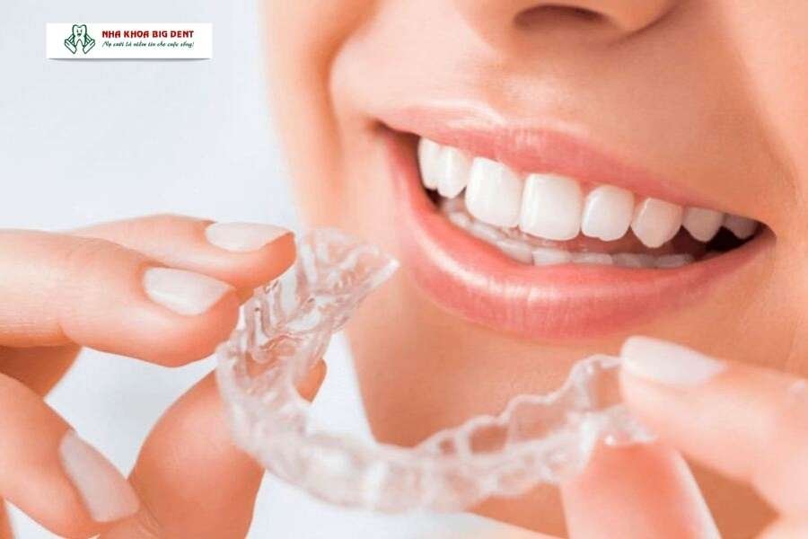 niềng răng trong suốt