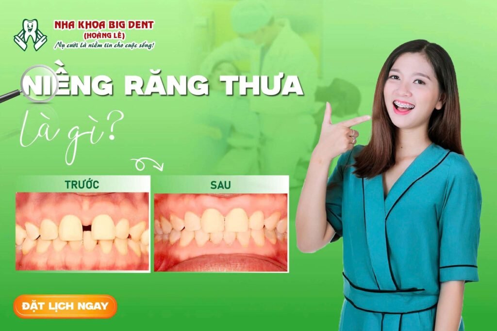 niềng răng thưa