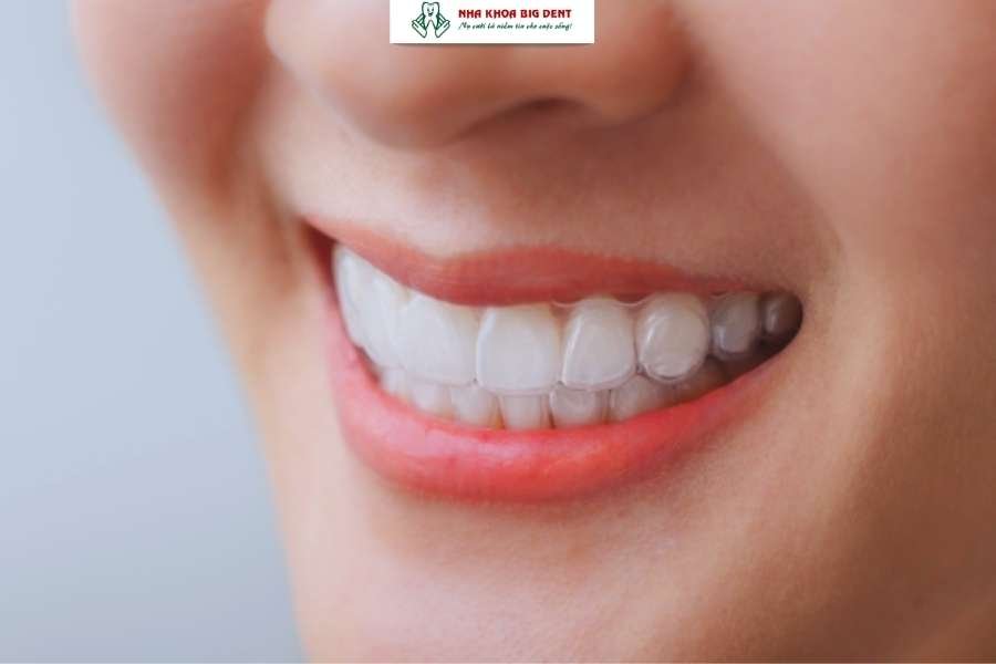 niềng răng trong suốt