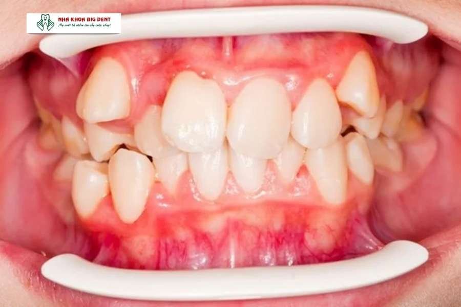 niềng răng trong suốt