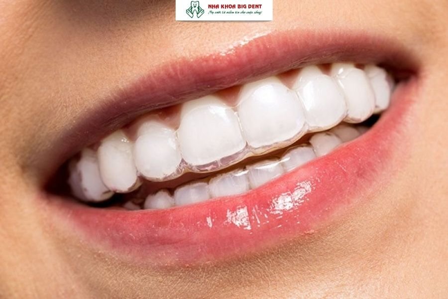 Niềng răng trong suốt mang lại thẩm mỹ vượt trội.