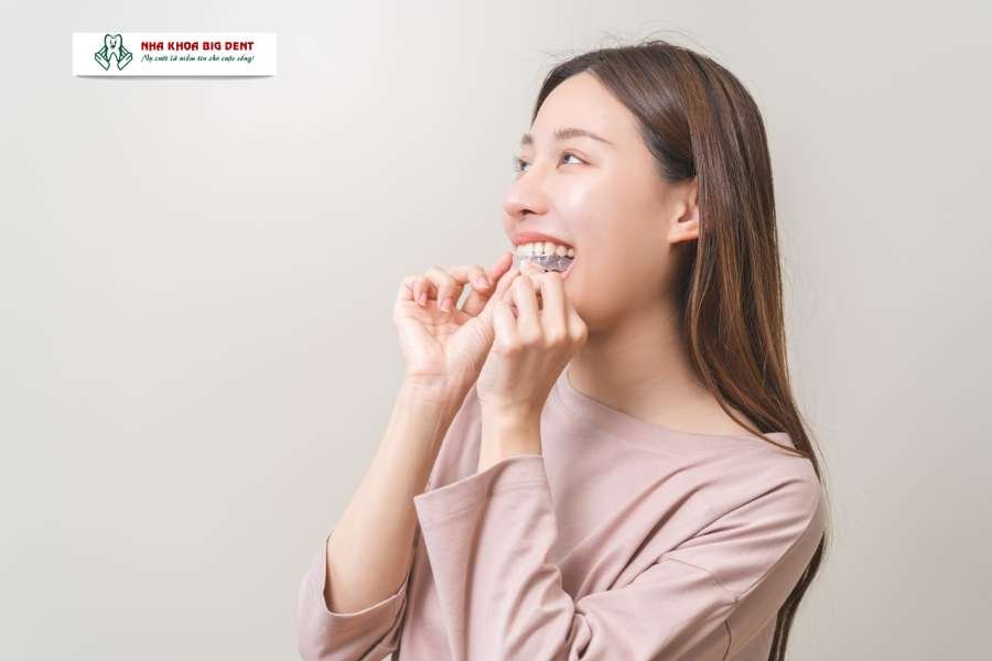 niềng răng trong suốt