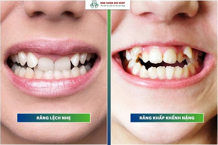 niềng răng trong suốt mất bao lâu
