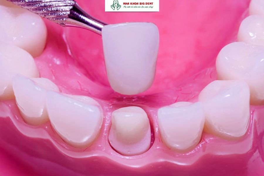 Bọc răng sứ giúp răng sáng màu và khít đều.