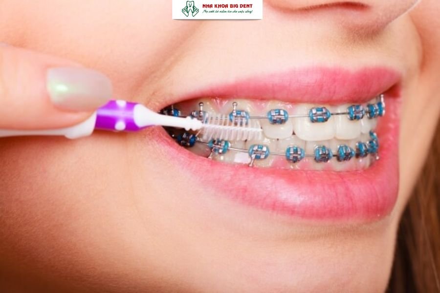vệ sinh răng miệng khi niềng răng