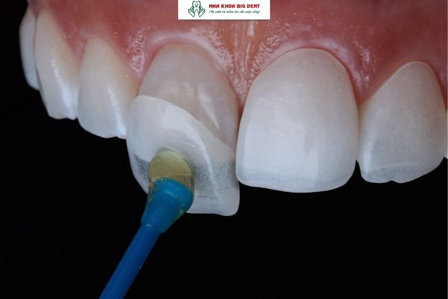 răng bị thưa sau khi niềng