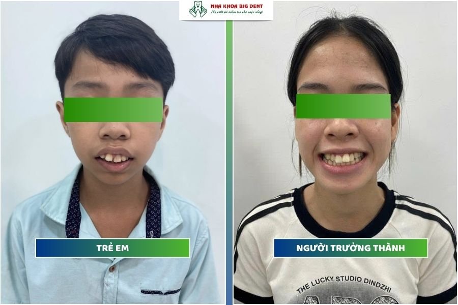 tuổi niềng răng