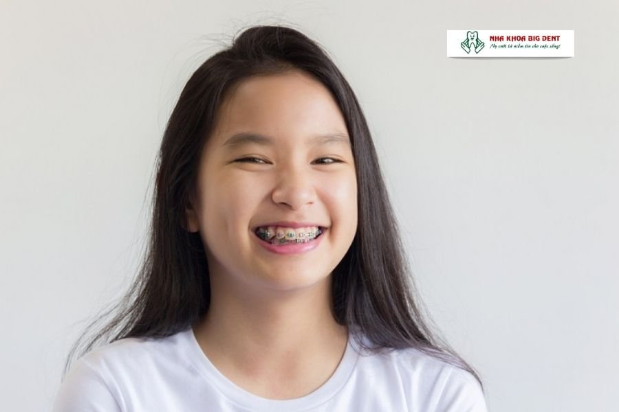 niềng răng trẻ emm