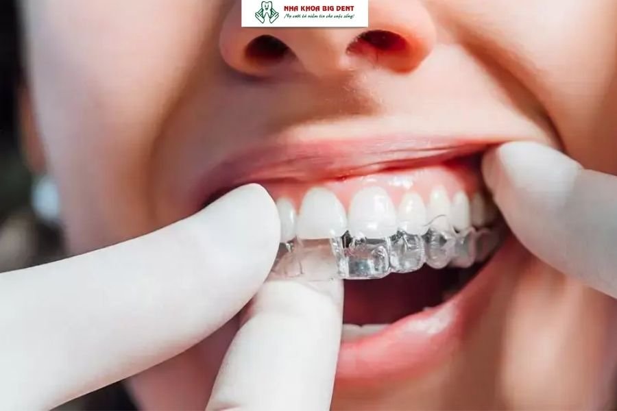 đeo hàm duy trì không vừa