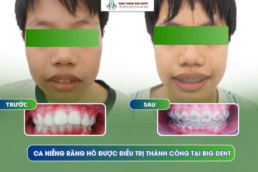 niềng răng hô thành công