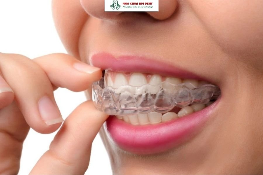 răng bị thưa sau khi niềng