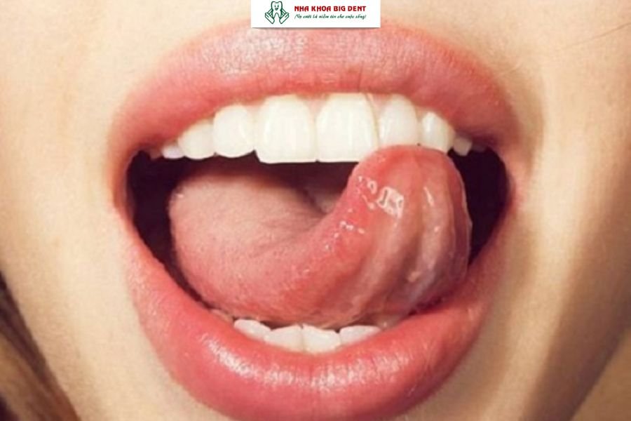 dùng lưỡi đẩy răng
