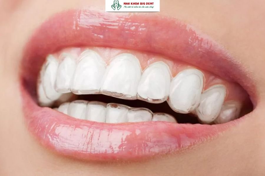 niềng răng trong suốt