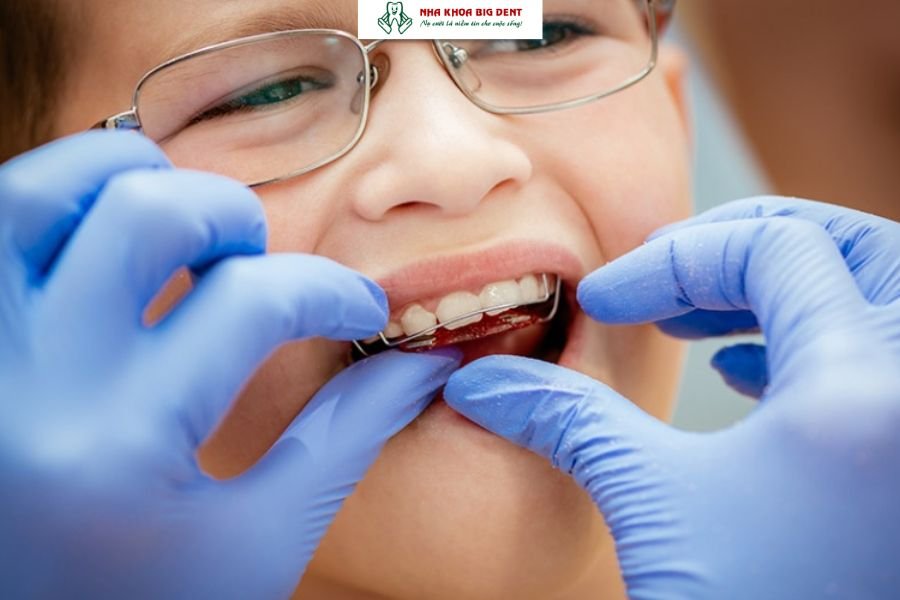 niềng răng bằng khí cụ tháo lắp