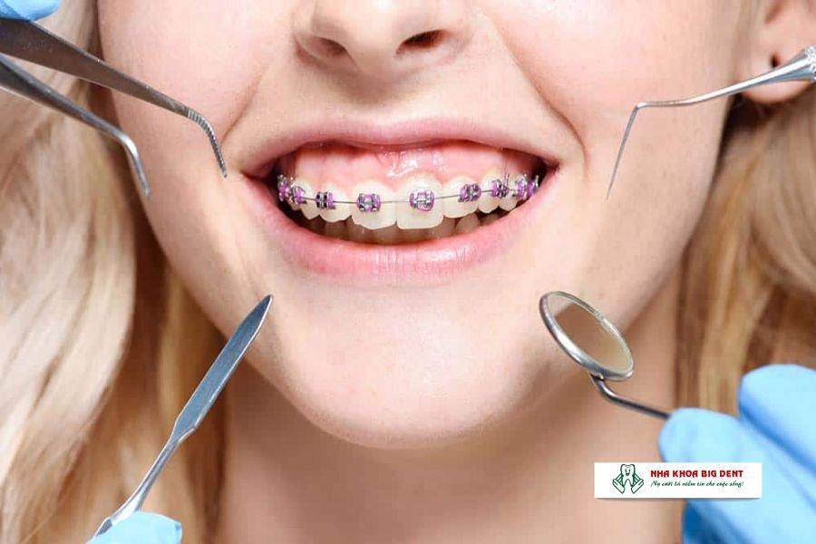 niềng răng bằng mắc cài thường