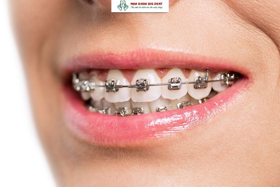 niềng răng mắc cài tự buộc