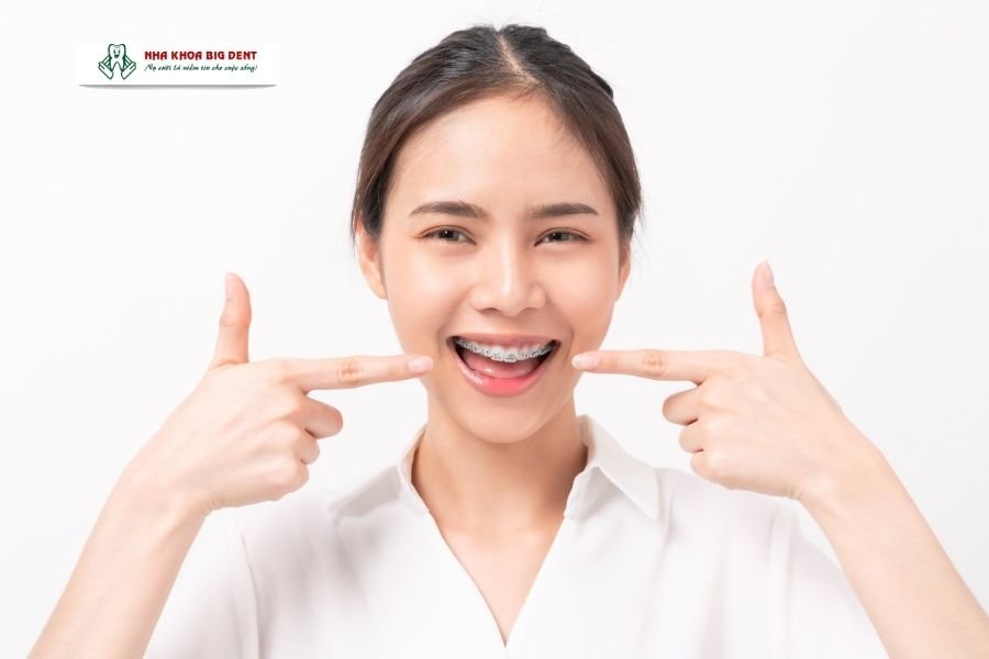 niềng răng trả góp cho sinh viên