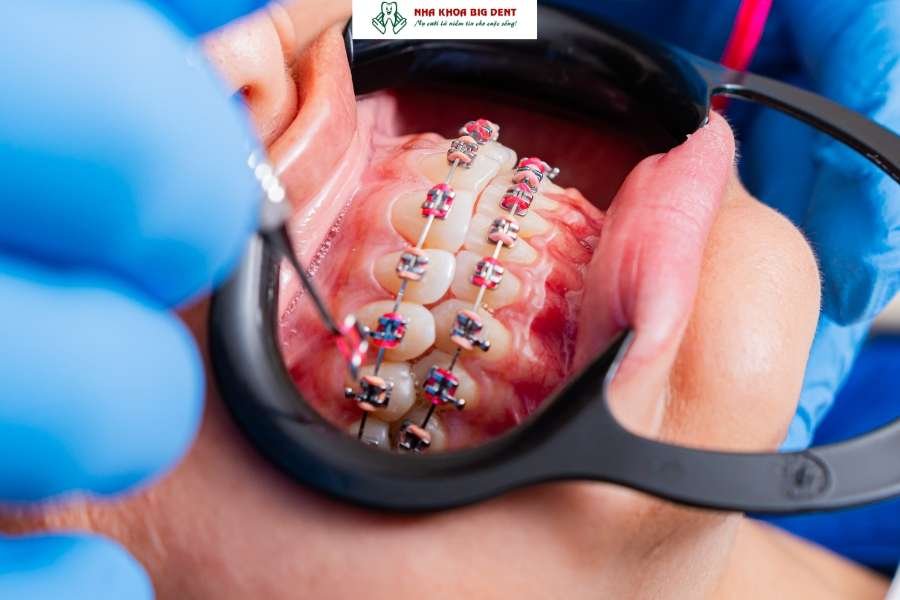 niềng răng mắc cài kim loại