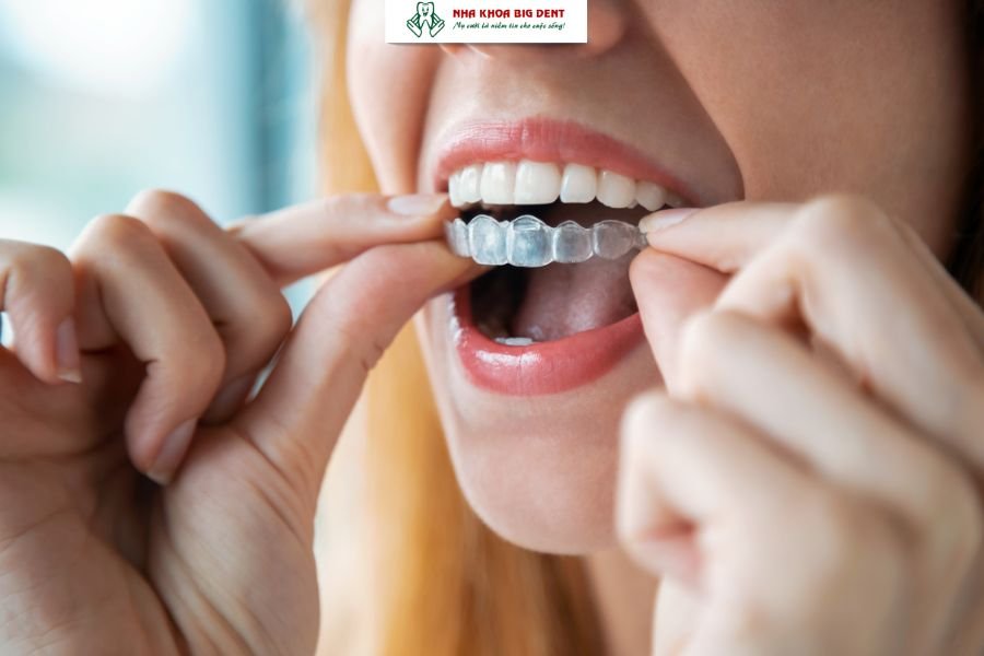 niềng răng trong suốt