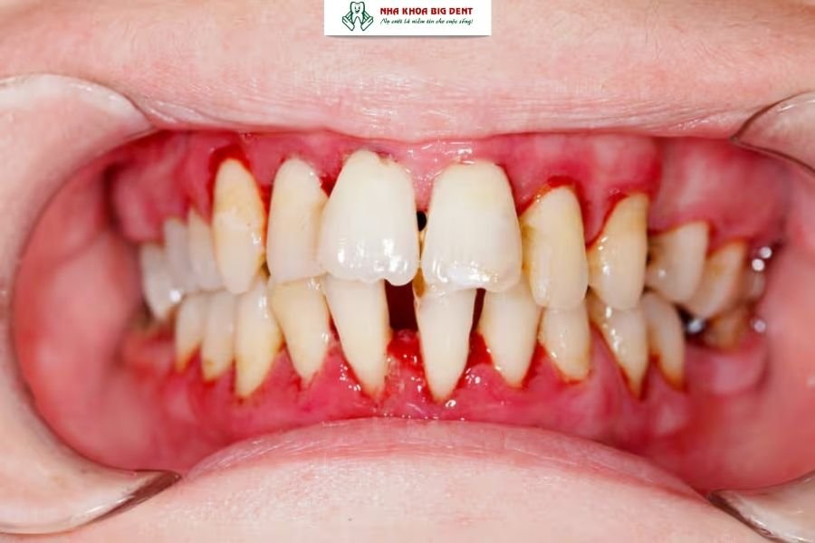 niềng răng trả góp cho sinh viên