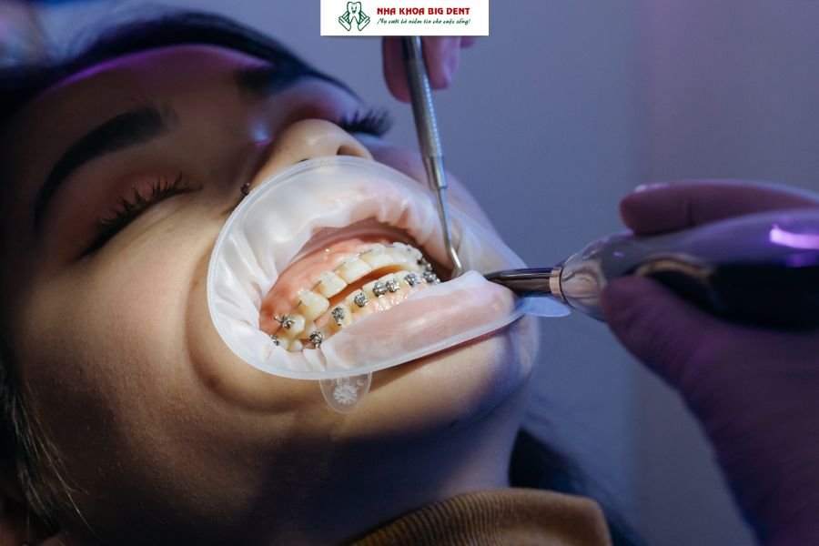 niềng răng lại