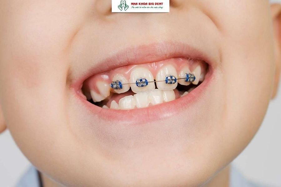 niềng răng trẻ em