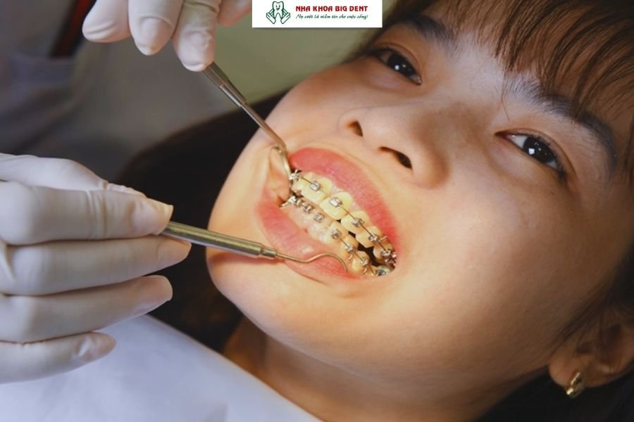 niềng răng trẻ em