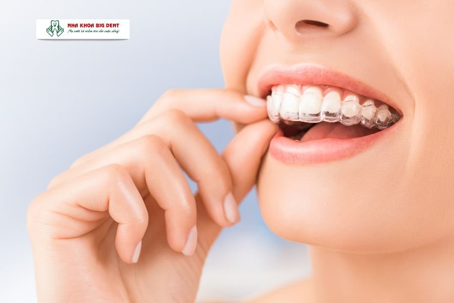 Niềng răng máng trong suốt.