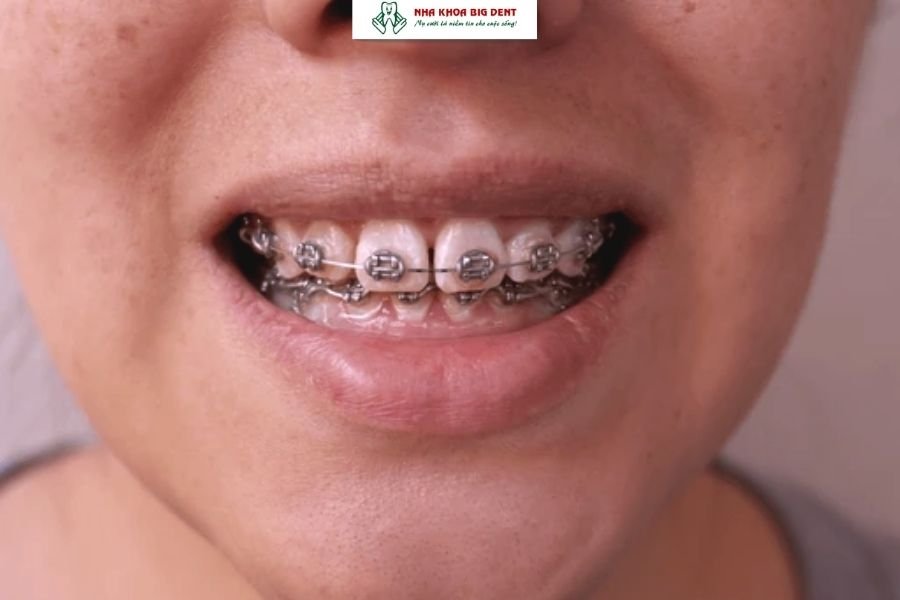 niềng răng thưa có cần nhổ răng không