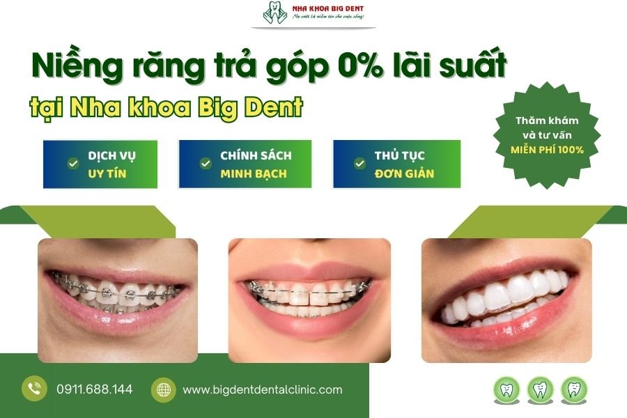 niềng răng trả góp