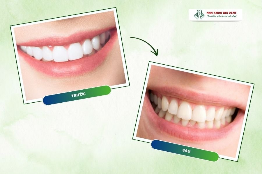 niềng răng xong bị hô lại