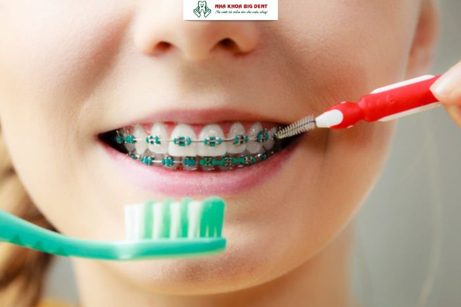 vệ sinh răng miệng cho trẻ khi niềng răng