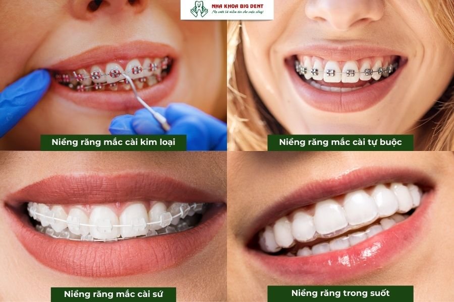 phương pháp niềng răng