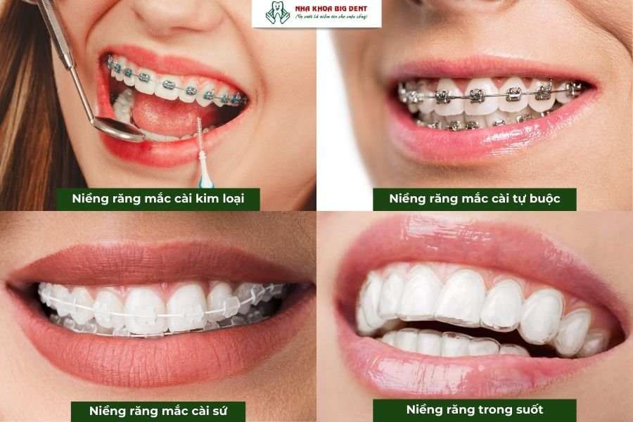 phương pháp niềng răng