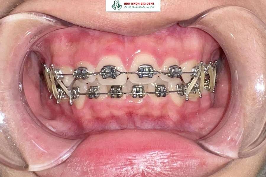 niềng răng hô