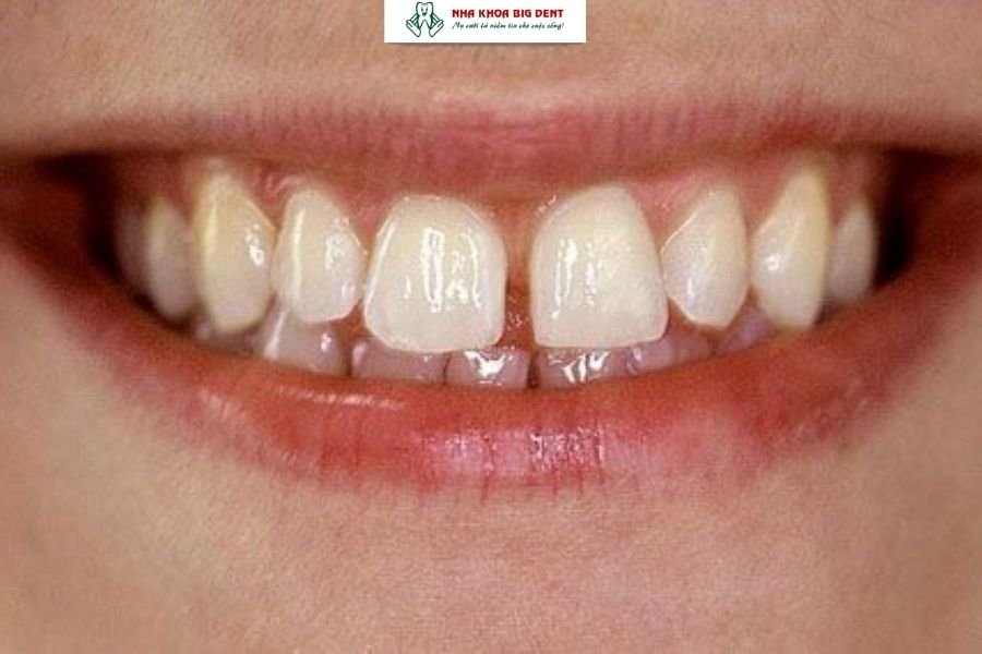 niềng răng thưa có cần nhổ răng không