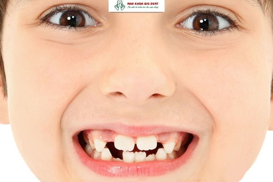 tình trạng răng ban đầu của trẻ