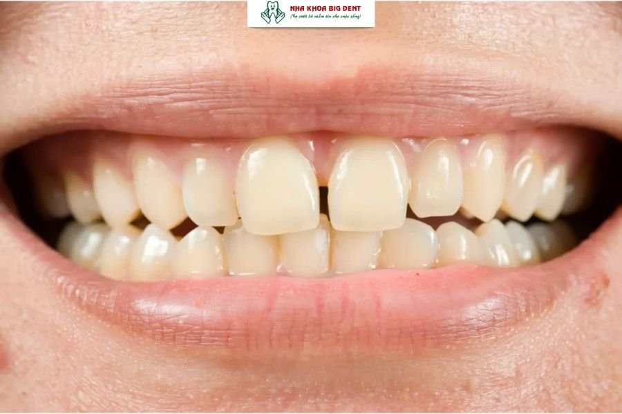 răng bị thưa sau khi niềng