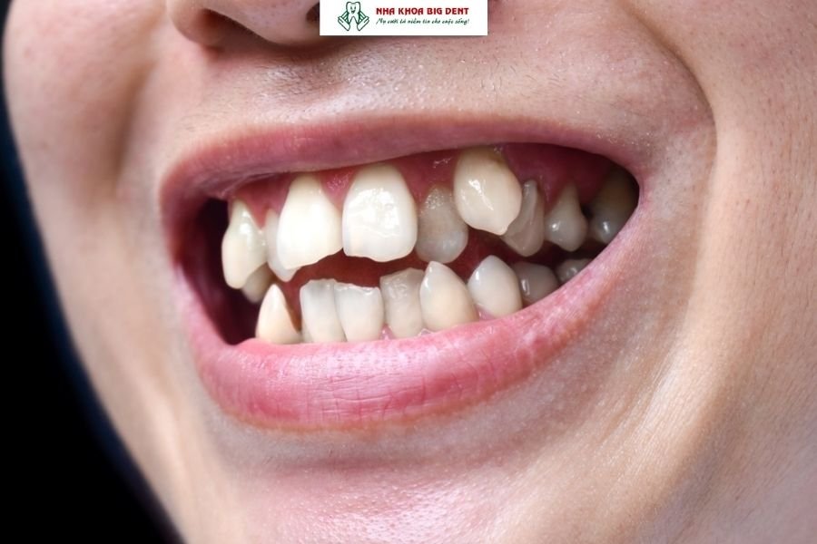 niềng răng thưa có cần nhổ răng không