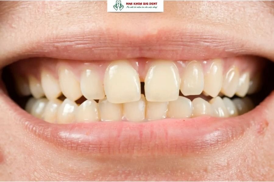 niềng răng thưa có cần nhổ răng không