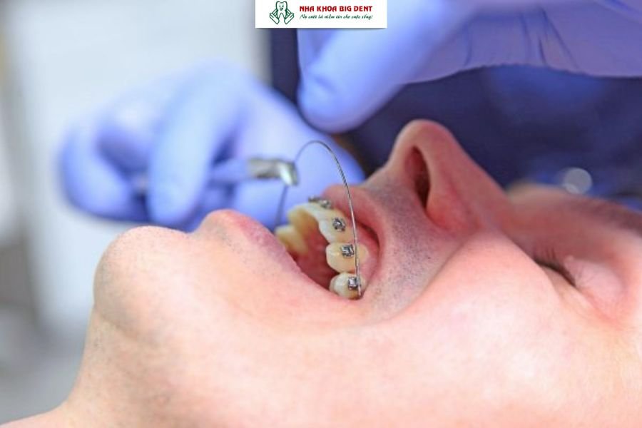 Tái khám định kỳ niềng