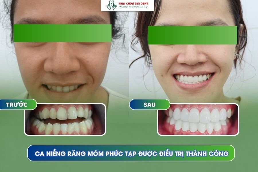 niềng răng móm