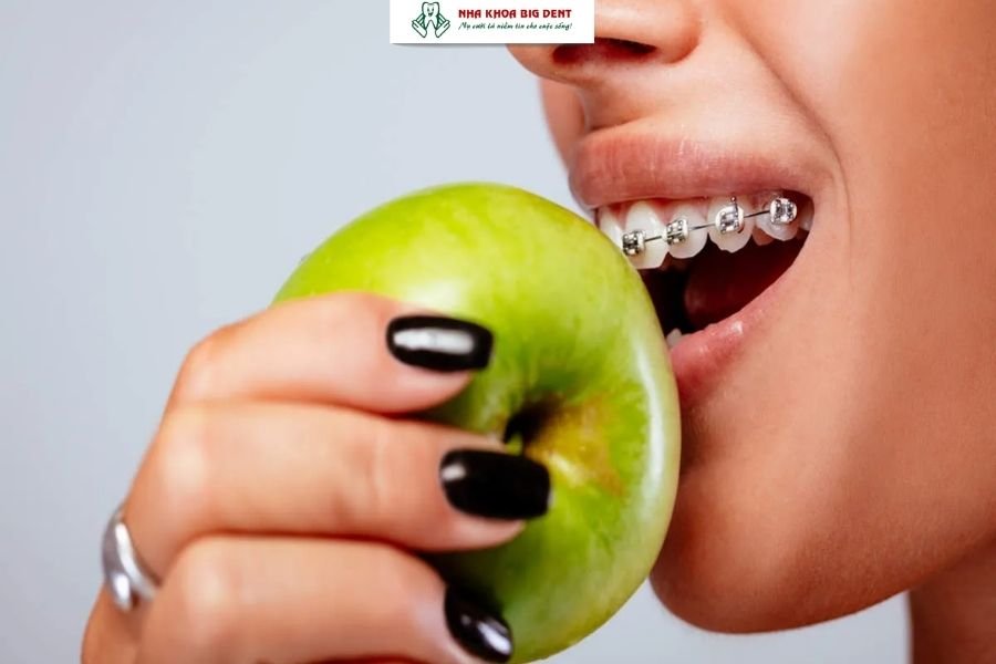 ăn uống không hợp lý sau niềng răng