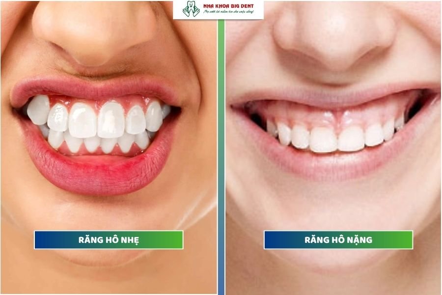 niềng răng hô bao nhiêu tiền phụ thuộc vào tình trạng hô ban đầu