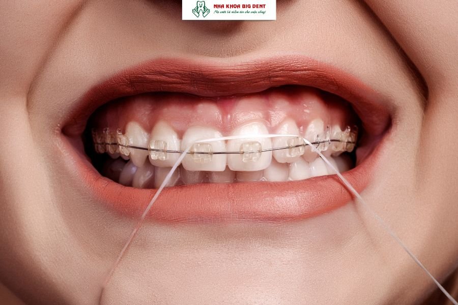 vệ sinh răng khi niềng